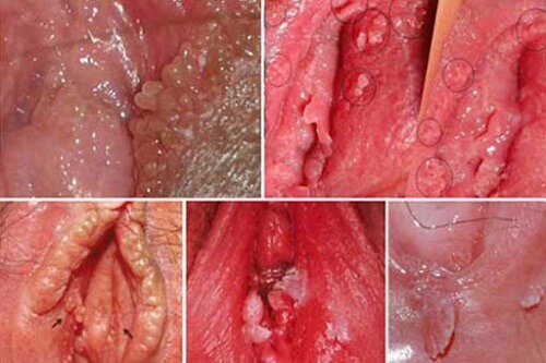 Ngứa vùng kín bên ngoài môi lớn do bệnh sùi mào gà